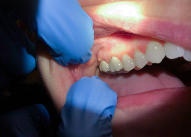 Best Emergency Denture Repair in Westmont, IL